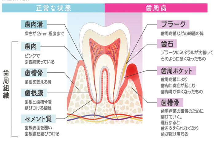 歯周病について図式化したもの
