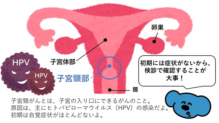 子宮頸がんのできる部位をイラストで説明したもの　子宮頸がんとは、子宮の入り口にできるがんのこと。主にヒトパピローマウイルス（HPV）の感染が原因です。
